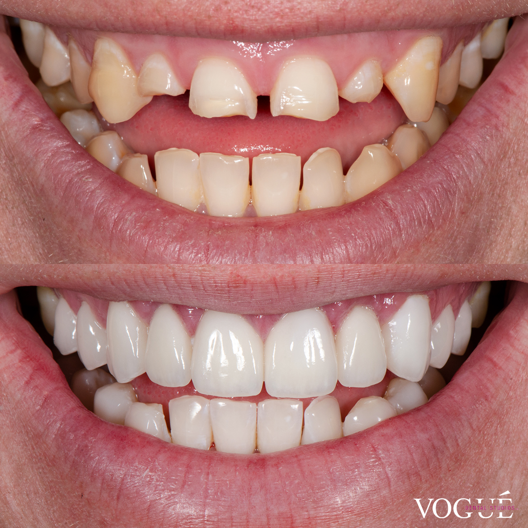 Before and after missing teeth with porcelain veneers at Vogue Dental Studios - front teeth view Dean A