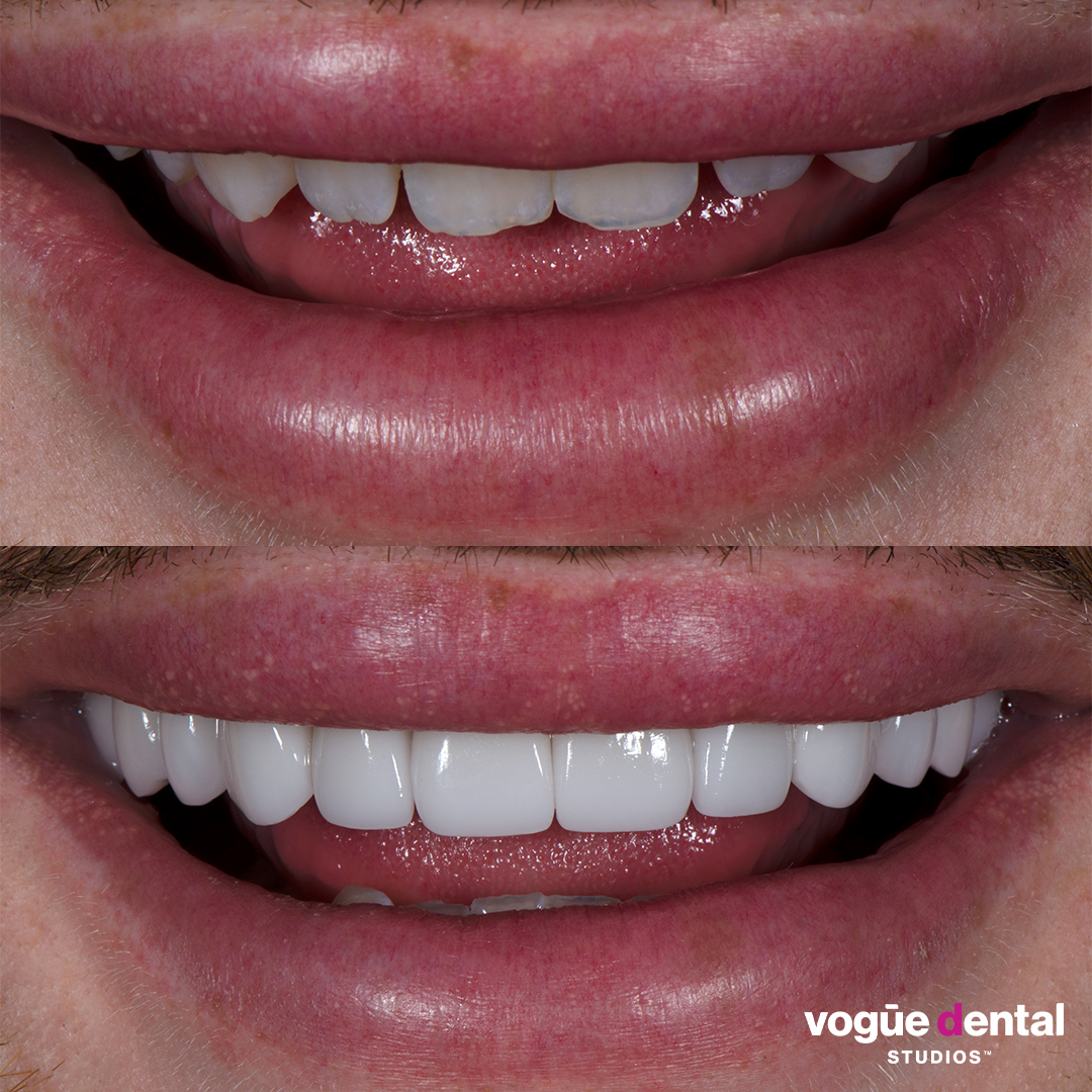 Michael Finch makeup artist before and after porcelain veneers at Vogue Dental Studios front teeth view.
