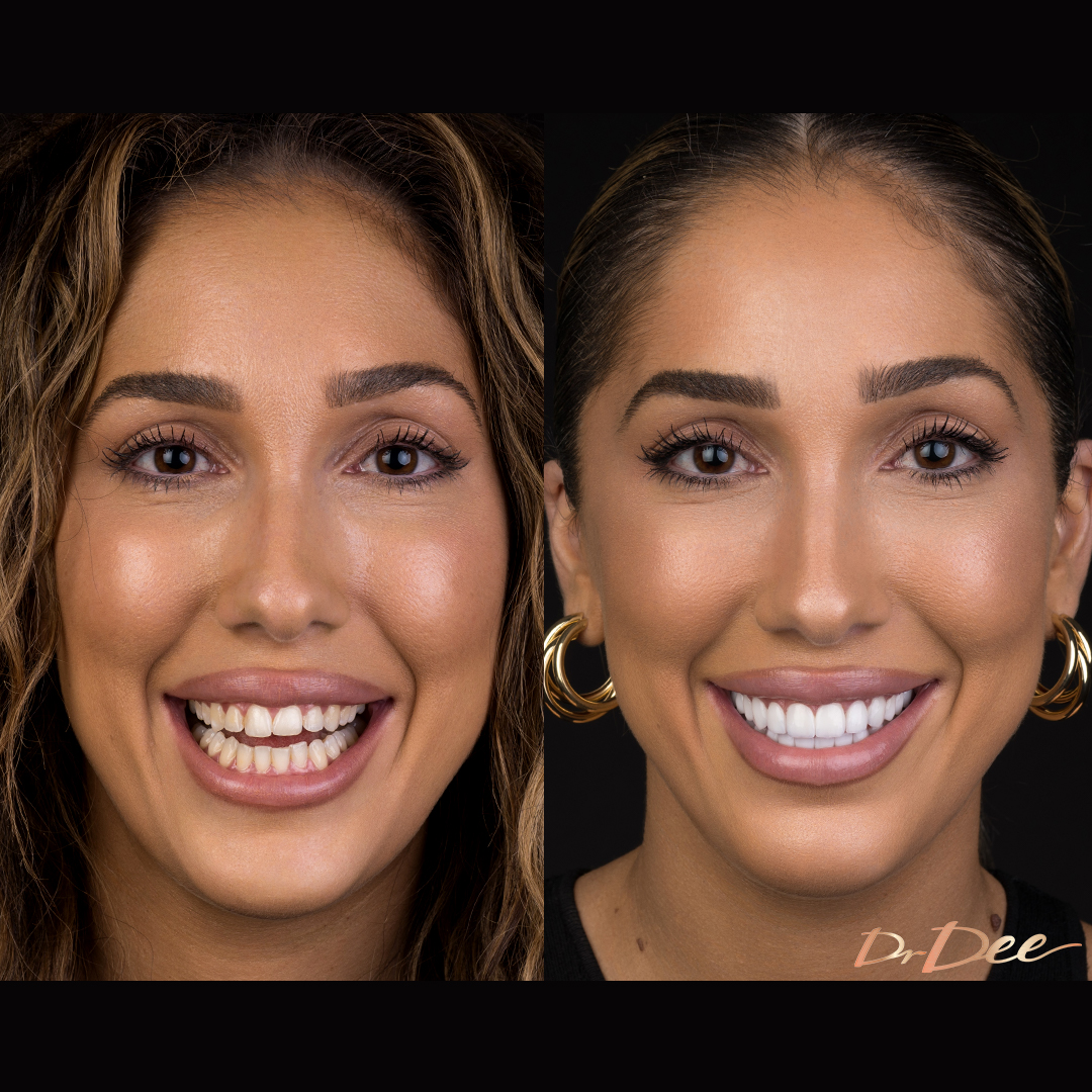 Before and after porcelain veneers smile makeover at Vogue Dental Studios - front face view Selin