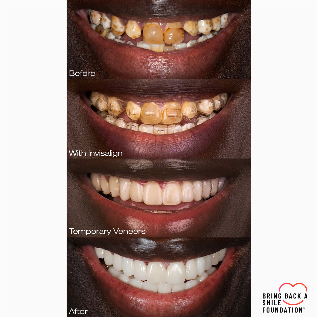 Isara a Bring Back a Smile Foundation receiver at different stages of complete smile makeover