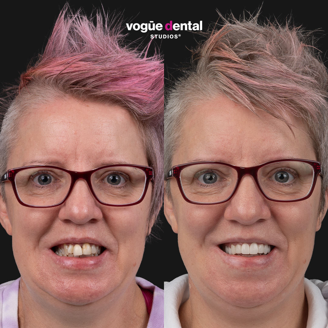 Kim Picasso Porcelain Veneers smile makeover at Bring Back a Smile Foundation - before and after