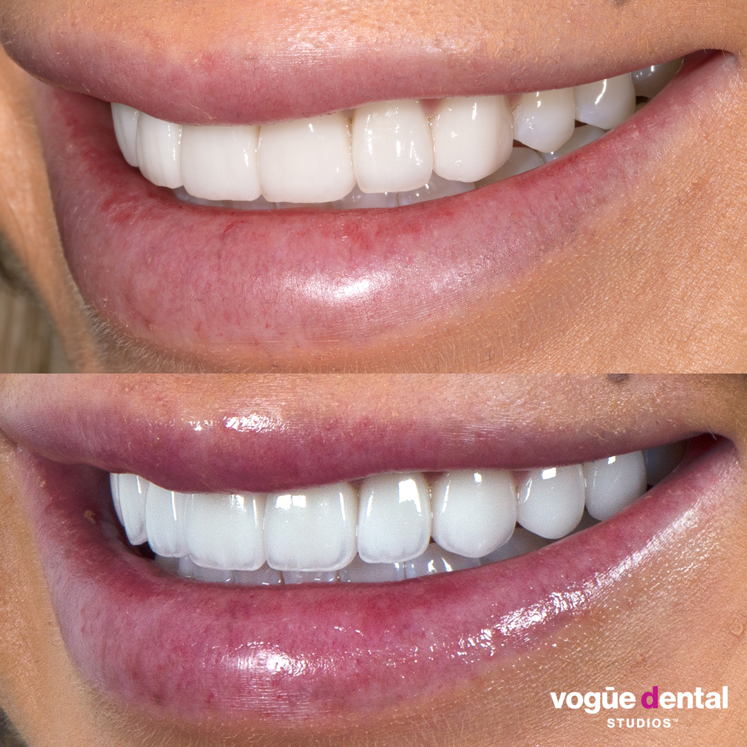 Before and after porcelain veneers smile makeover at Vogue Dental Studios - left teeth view Elise