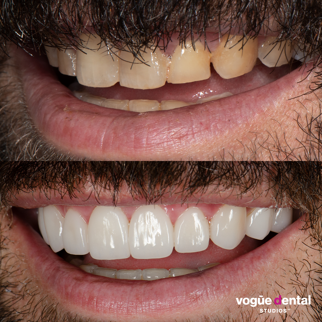 Before and after porcelain veneers Anthony rounded shapes - left smile view