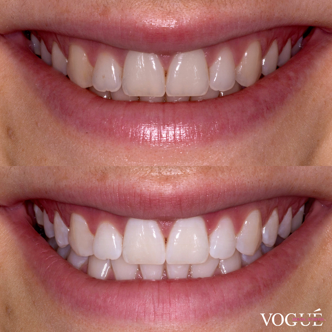 Before and after in-chair teeth whitening at Vogue Dental Studios - front teeth view Emma.