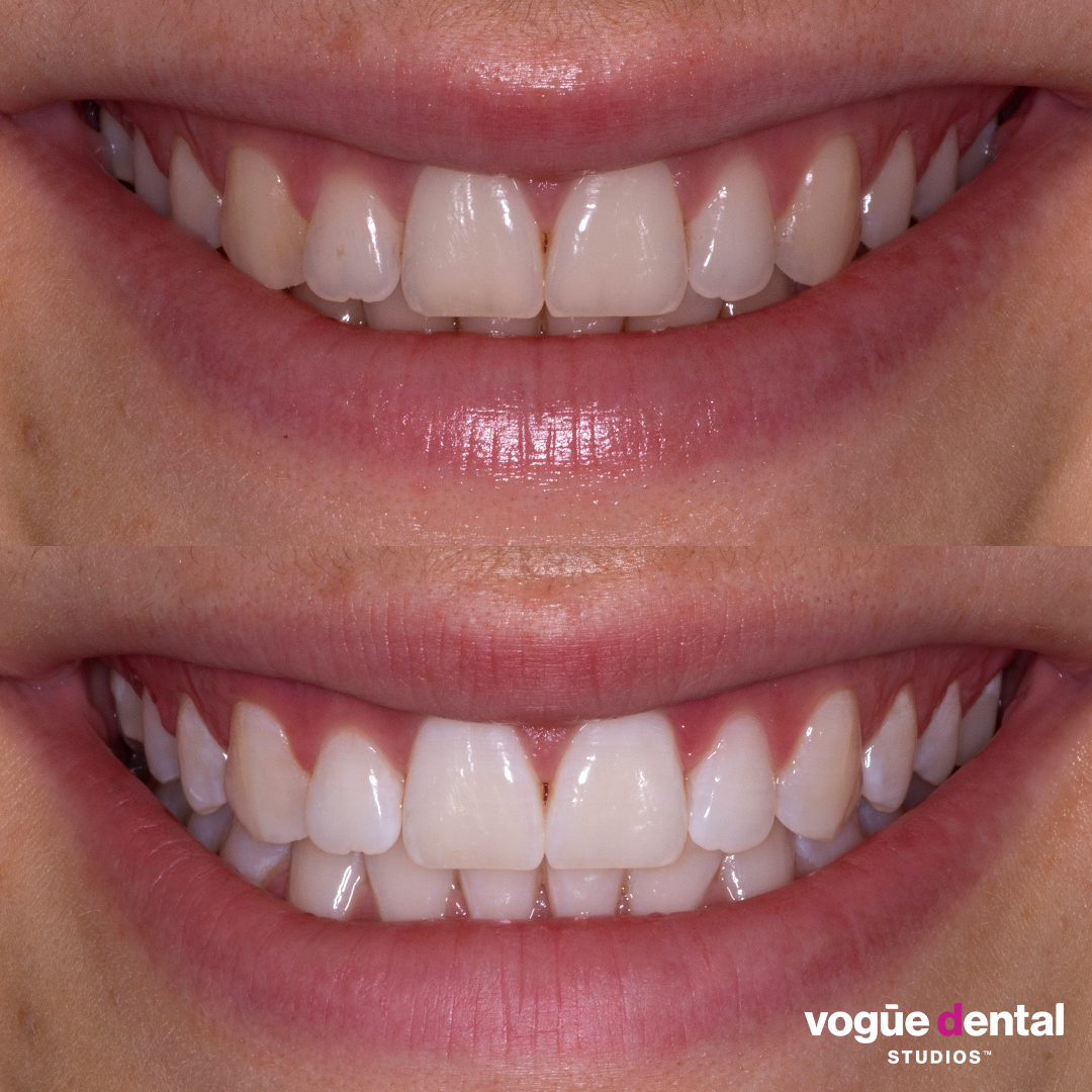 Before and after in-chair teeth whitening at Vogue Dental Studios - front teeth view Emma.