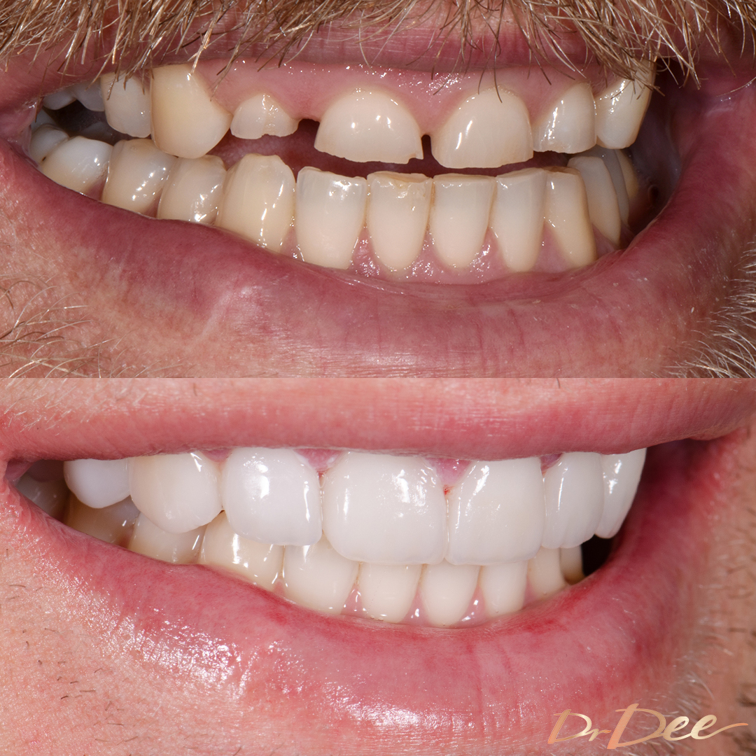 Jake Edwards smile makeover right teeth view.