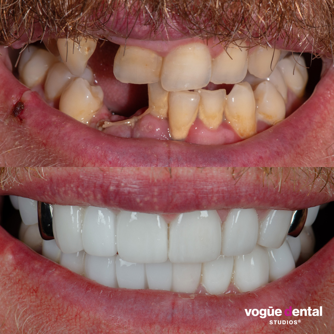 Before and after porcelain veneers and white gold teeth smile makeover at Vogue Dental Studios - front view Trent