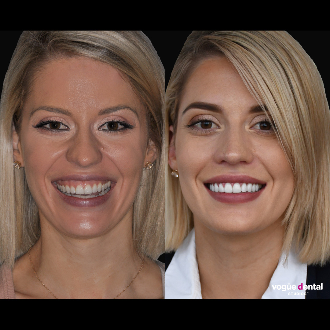 Before and after gummy smile and smile cant correction with porcelain veneers at Vogue Dental Studios - face view Cassie.