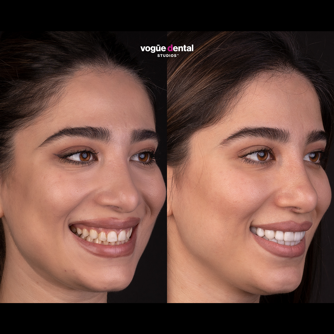 Before and after porcelain veneers at Vogue Dental Studios - Side Face View Mina