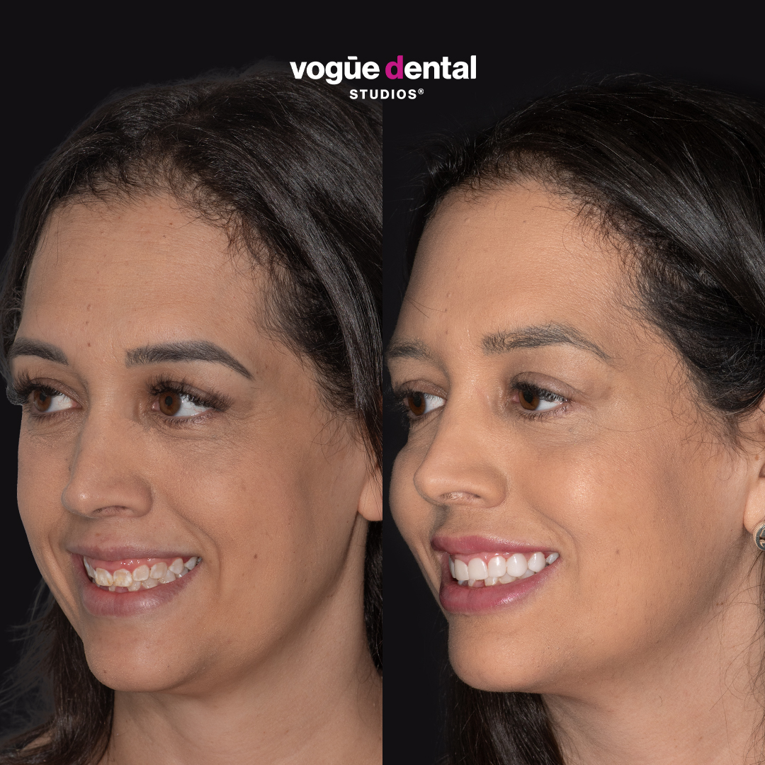 Paula gummy smile before and after at Bring Back a Smile Foundation