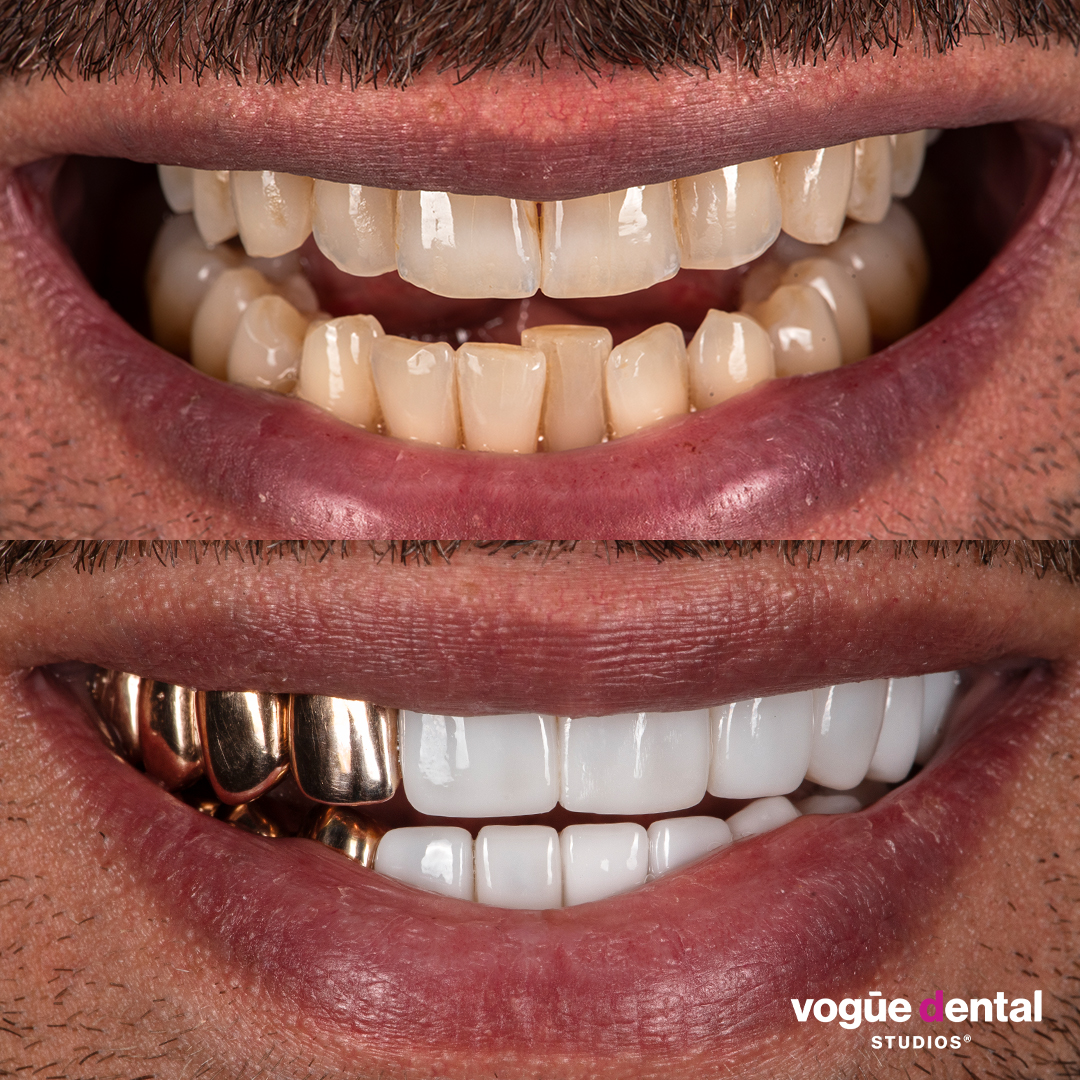 Before and after porcelain veneers smile makeover at Vogue Dental Studios - front view, Kris
