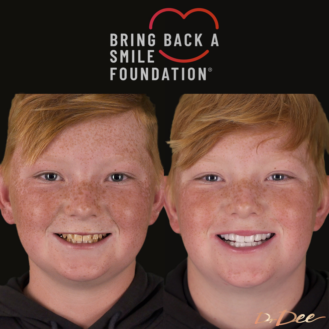 Cooper has a genetic condition no enamel restorative dentistry through porcelain veneers.