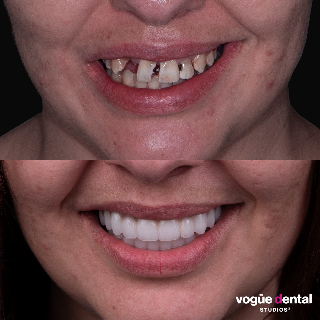 Before and after implant smile makeover at Vogue Dental Studios - front teeth view Pia