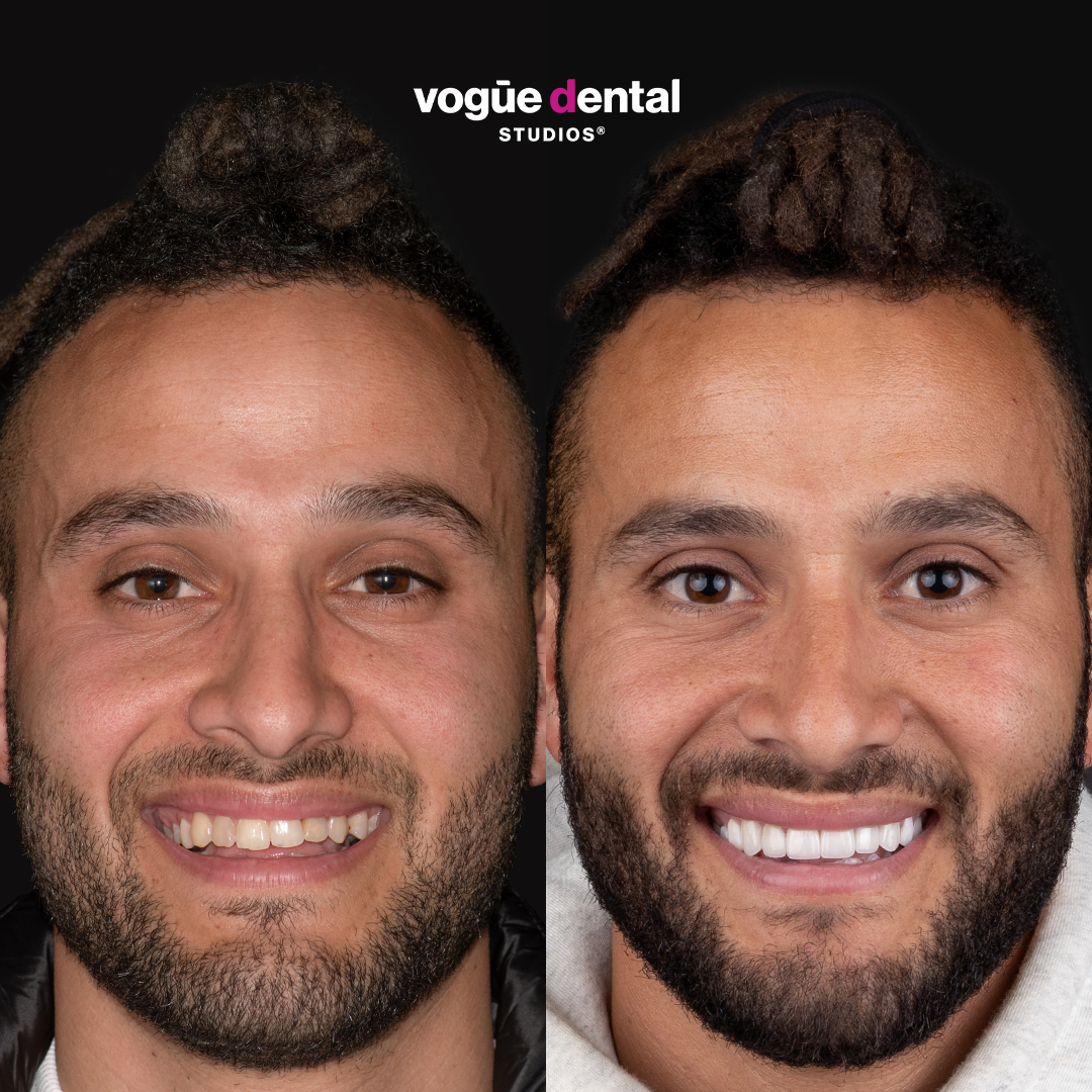 Before and after porcelain veneers and missing tooth at Vogue Dental Studios - front view Mousty