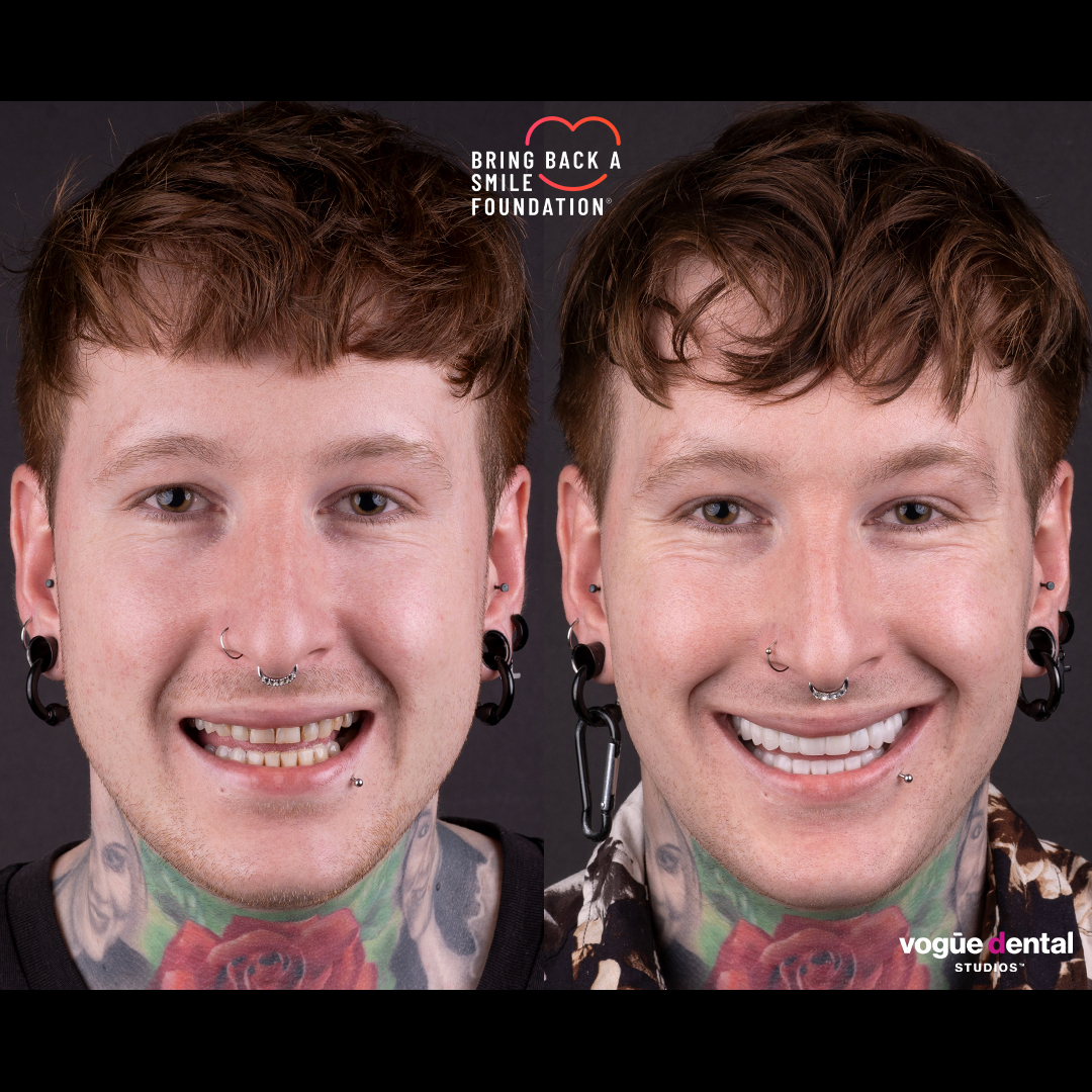 Nathan smile makeover before and after at Bring Back a Smile Foundation