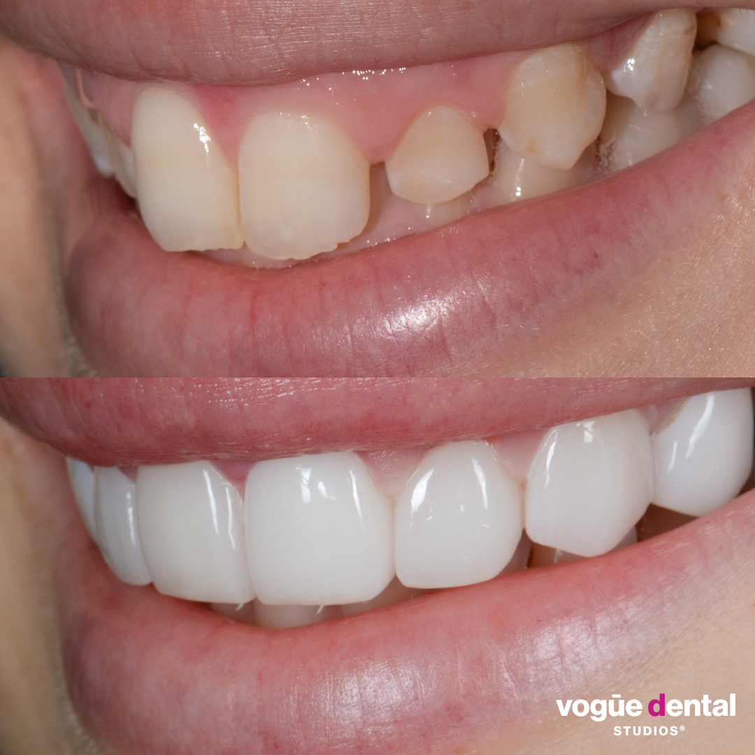 Before and after with Picasso Ultra Hybrid veneers at Vogue Dental Studios - side teeth view Lili.