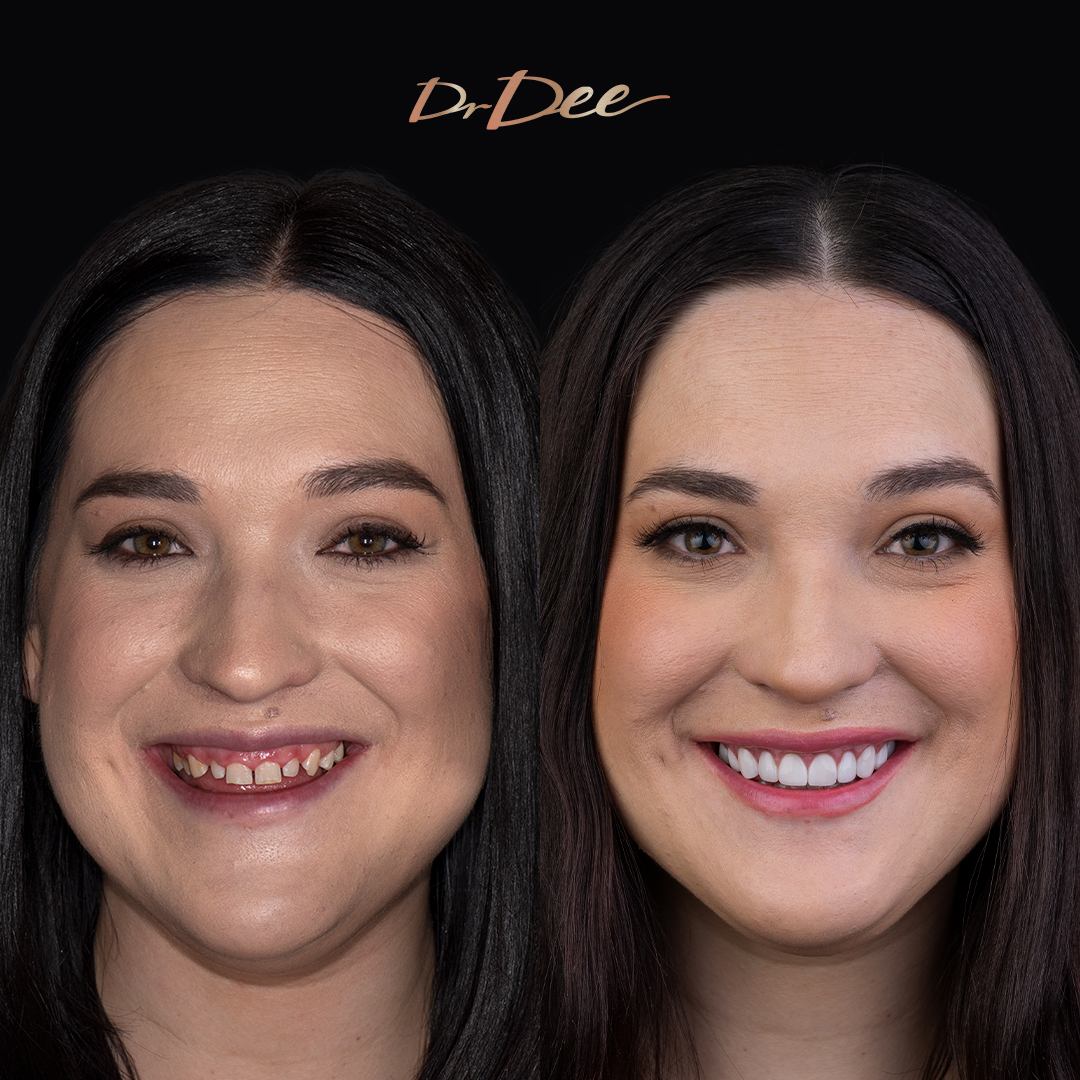 Marina gummy smile with gaps before and after veneers at Bring Back a Smile Foundation