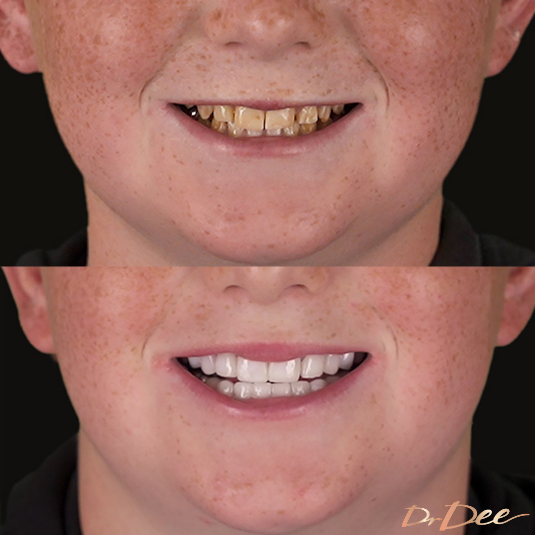 Cooper's teeth transformation after genetic condition with no enamel.