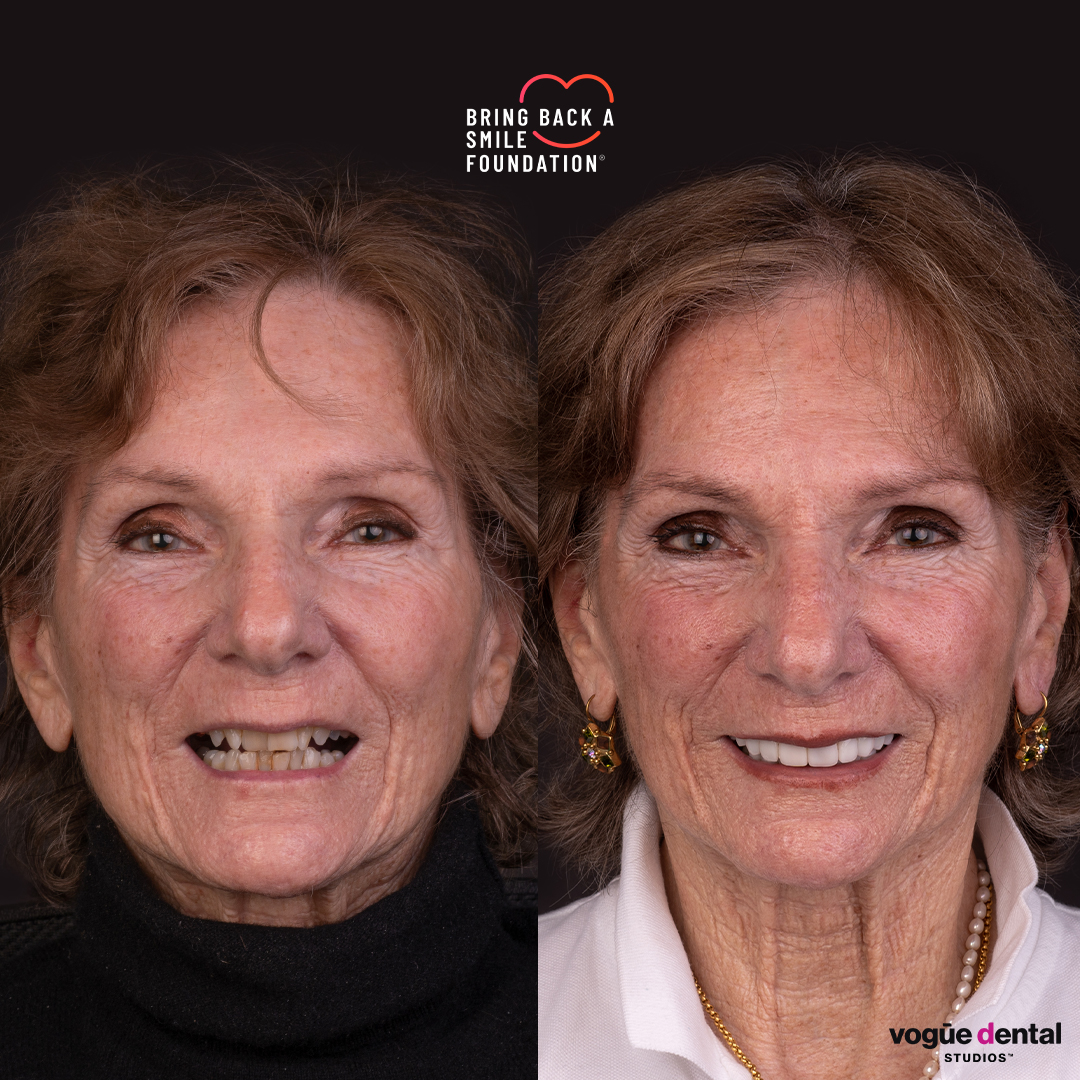 Anna, a cancer patient, before and after her smile makeover with porcelain veneers - front view