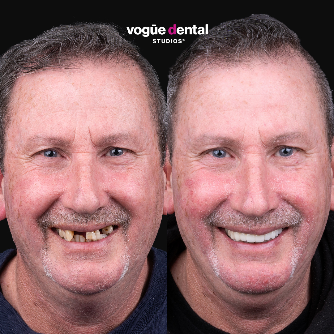 David several missing teeth smile restoration from smile makeover giveaway at Vogue Dental Studios