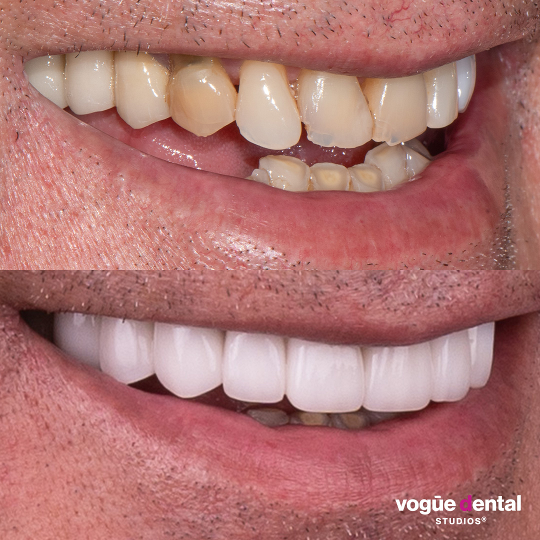 Before and after porcelain veneers and implant smile makeover at Vogue Dental Studios - side teeth view Tom