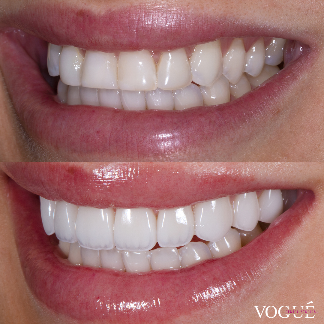 Kayla Itsines before and after porcelain veneer smile makeover front teeth view.