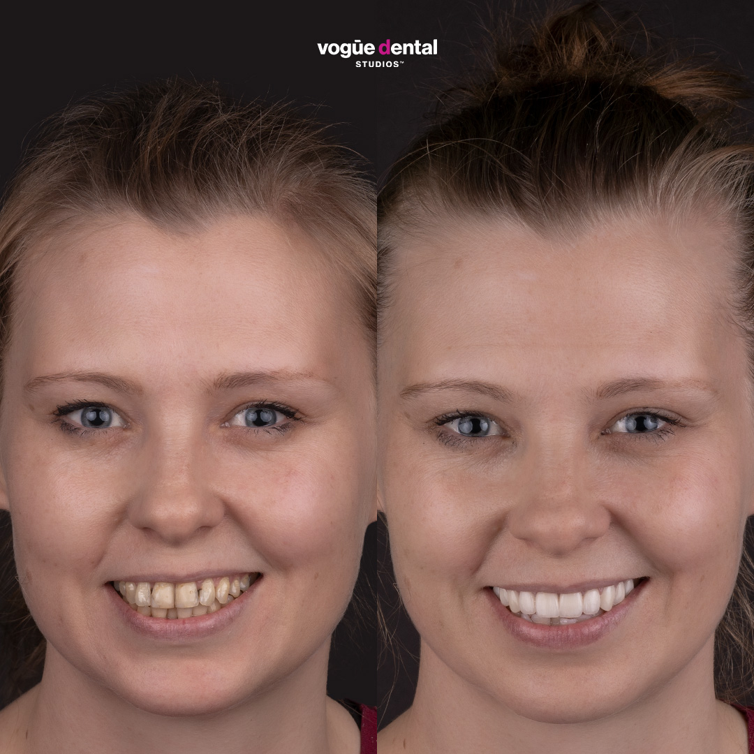 Elisabeth before and after thin enamel smile makeover Bring Back a Smile Foundation - full face