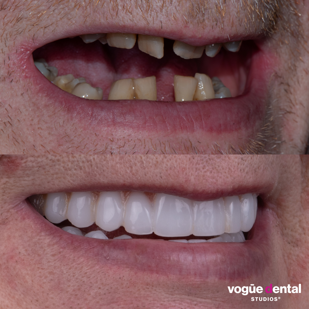 Before and after implant smile makeover at Vogue Dental Studios - right teeth view Damian