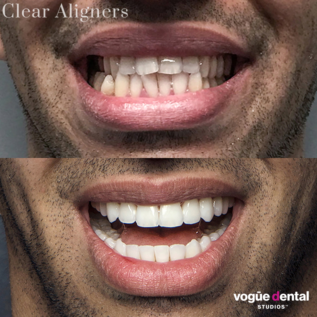 Before and after Invisalign full and teeth whitening at Vogue Dental Studios - Sam front face view.