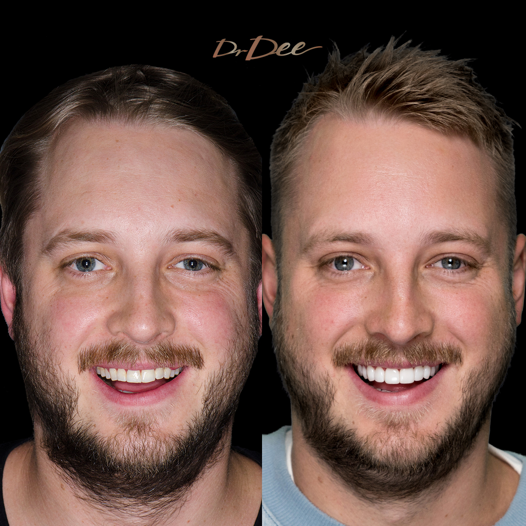Before and after porcelain veneers for grinding damage - front face view Dylan