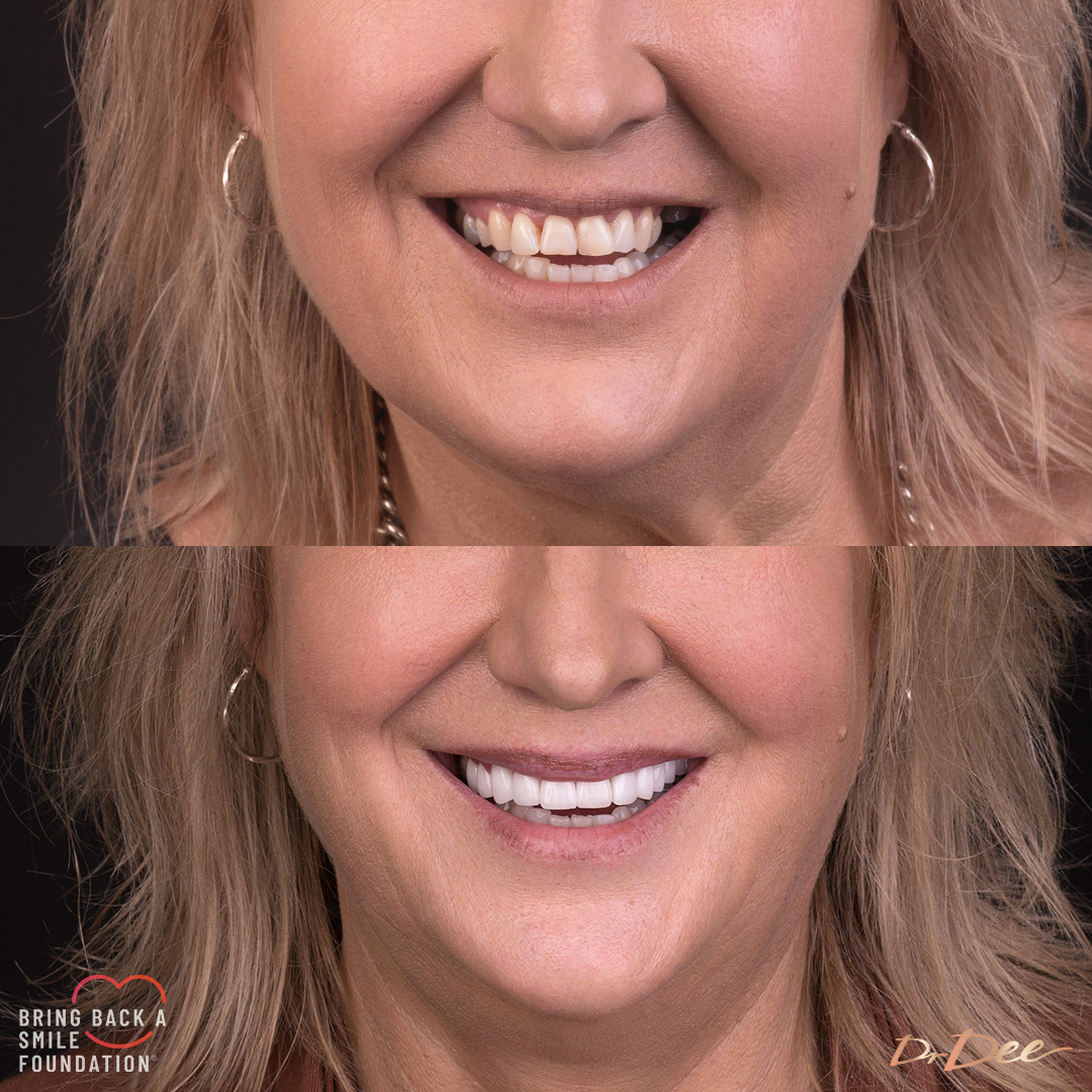Bring Back a Smile Foundation patient before and after veneers crowded teeth