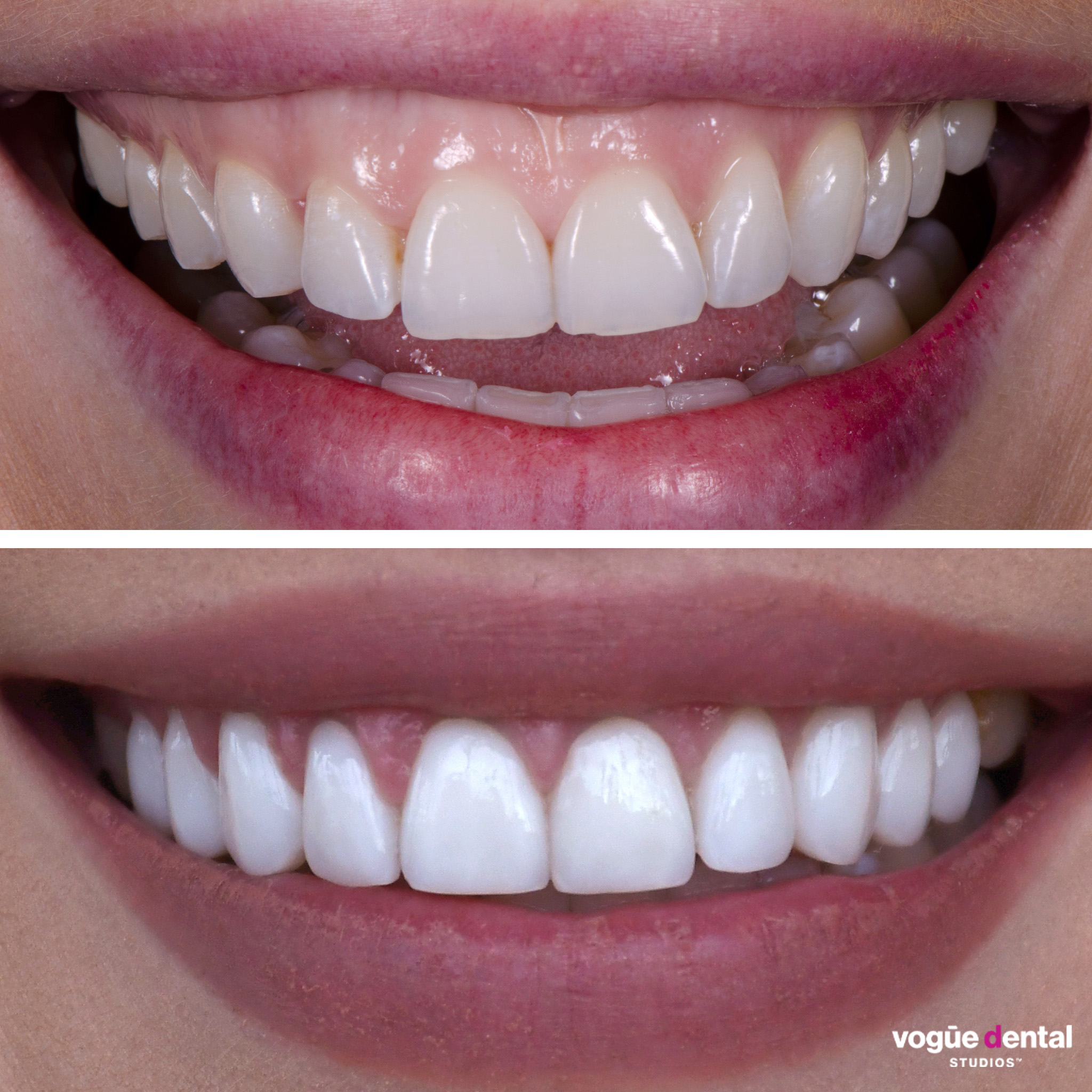 Before and after gummy smile and smile cant correction with porcelain veneers at Vogue Dental Studios - front view Cassie.