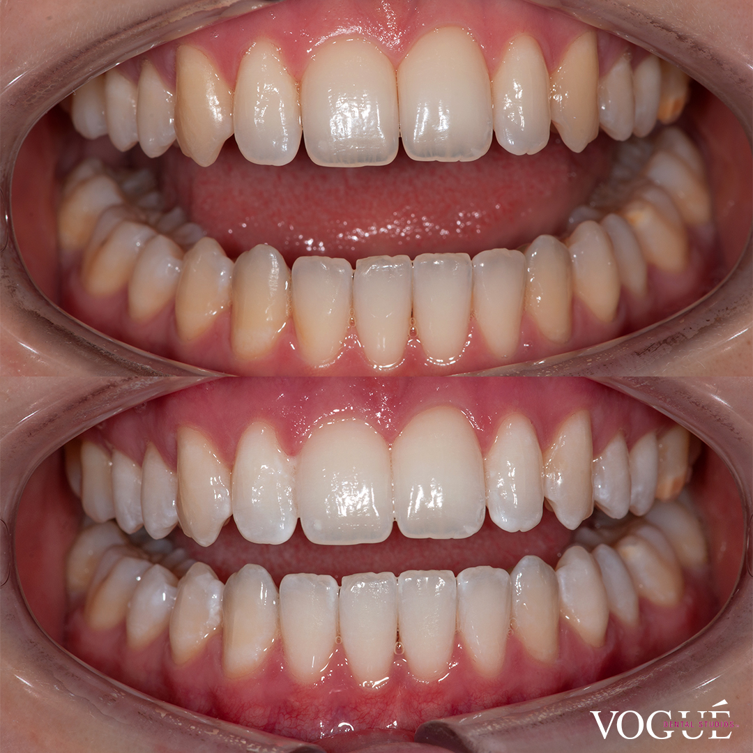 Before and after results of in-chair teeth whitening at Vogue Dental Studios. Maddy