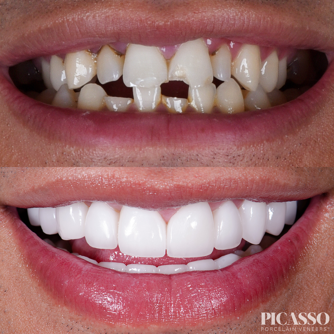 James Harder before and after restorative veneers.