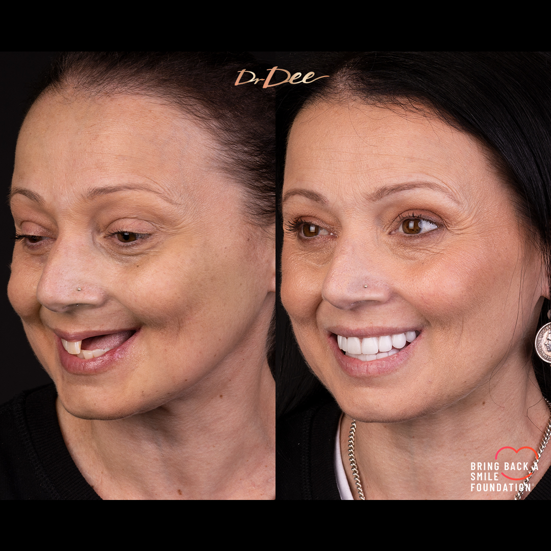 Nancy chemotherapy extracted teeth smile makeover at Bring Back a Smile Foundation