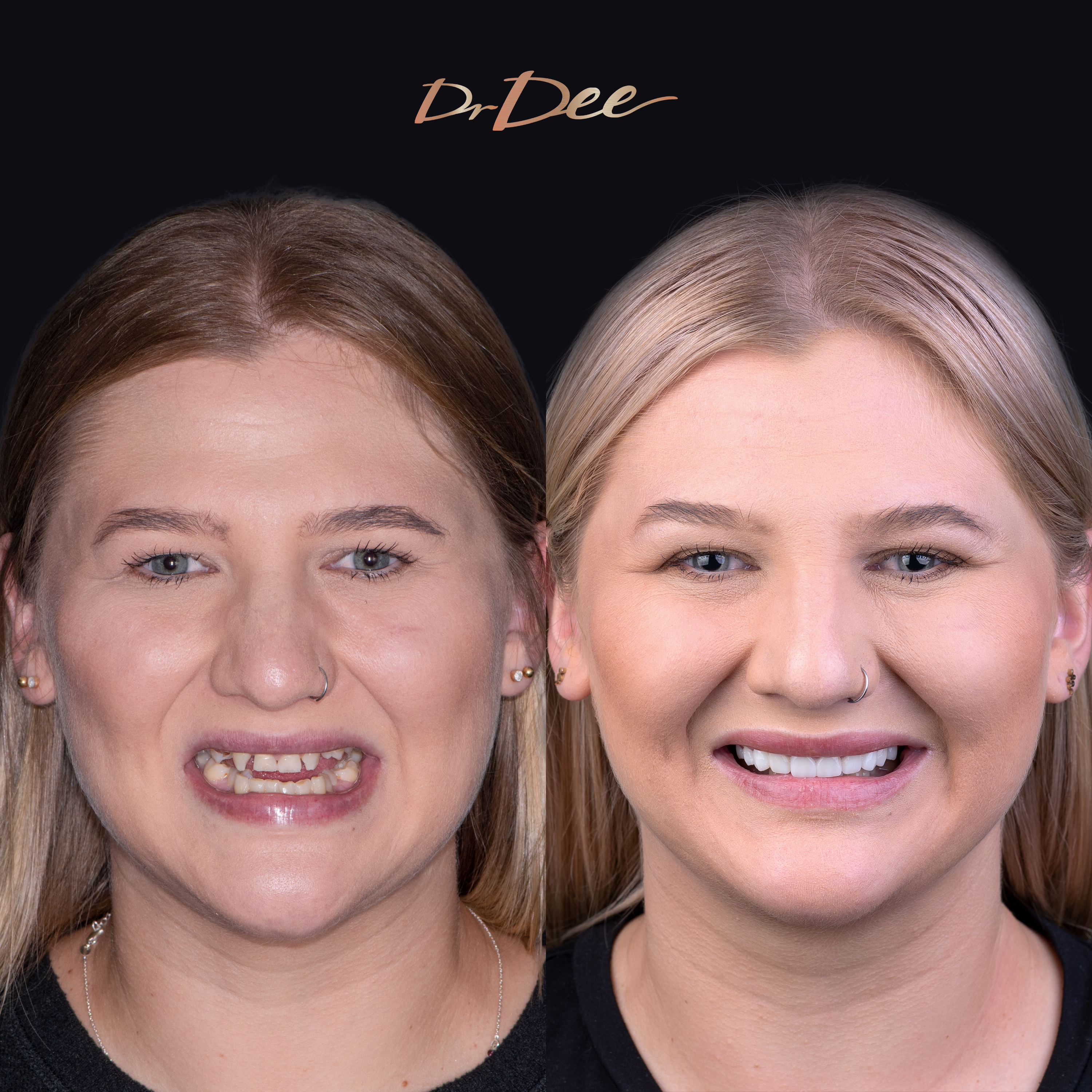Shai before and after smile makeover for gappy smile at Vogue Dental Studios
