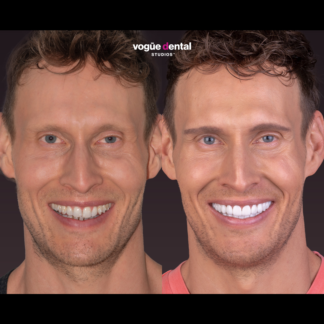 Before and after smile makeover Luke Hines - front face view