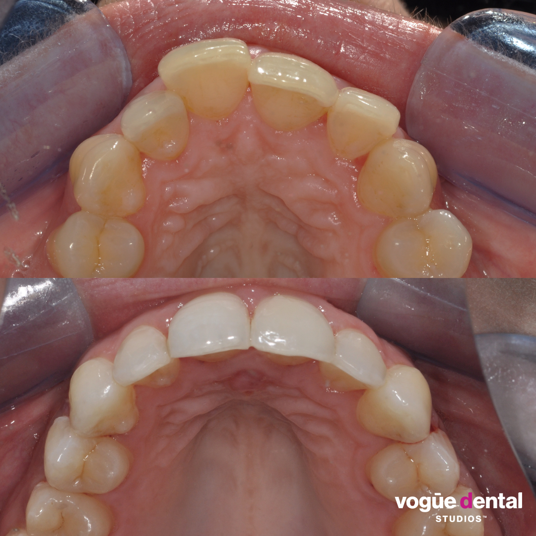 Before and after Invisalign full and teeth whitening at Vogue Dental Studios - top view Caitlin.