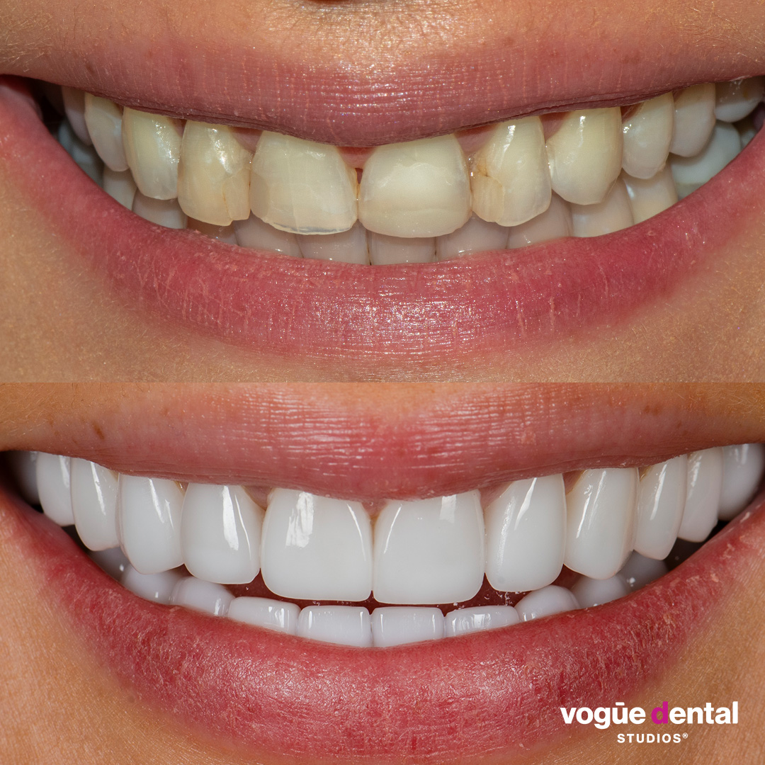 Before and after with Picasso Porcelain veneers at Vogue Dental Studios - front view teeth view Dzenana.