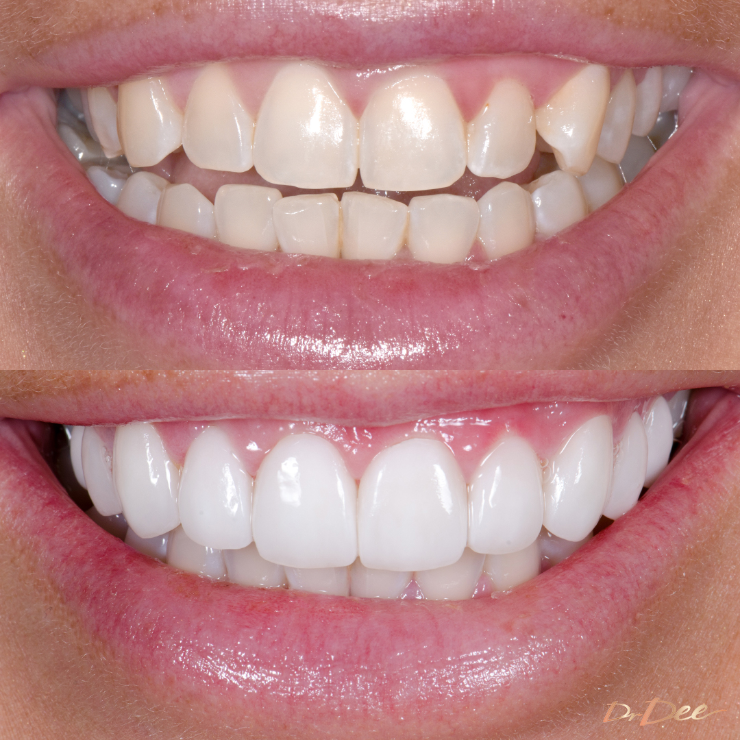 Before and after porcelain veneers at Vogue Dental Studios - front smile view Krystell