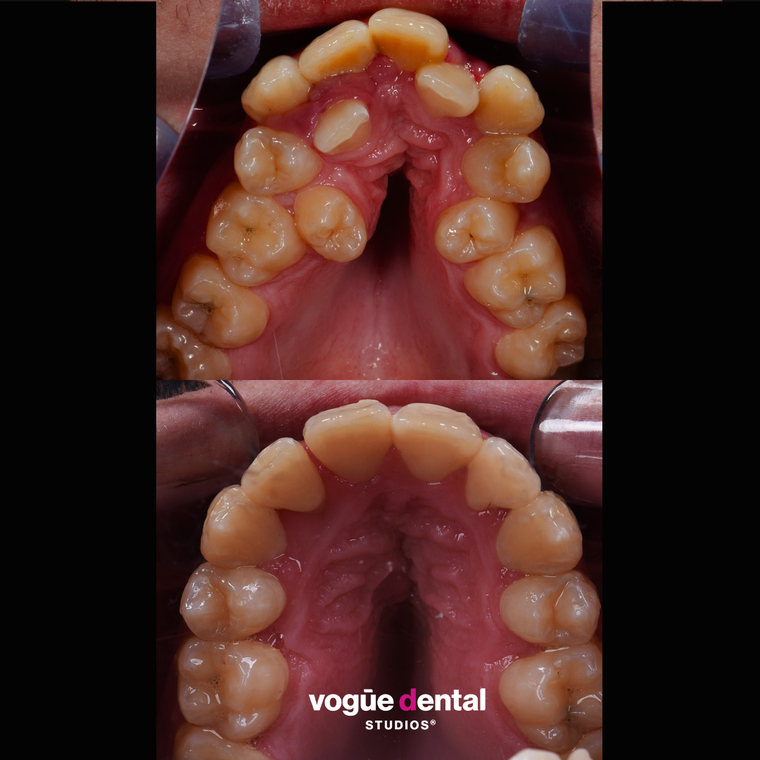 Floyd's case was complex which required braces and veneers