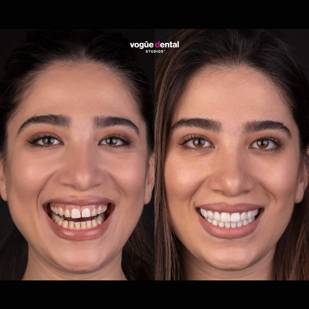 Before and after porcelain veneers at Vogue Dental Studios - Face View Mina