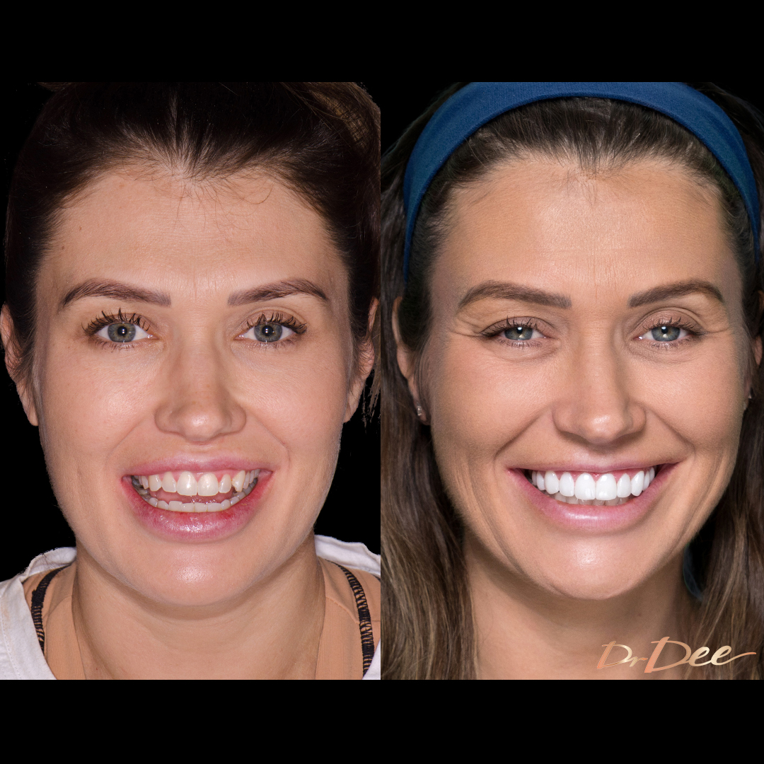 Before and after porcelain veneers at Vogue Dental Studios - front face view Krystell