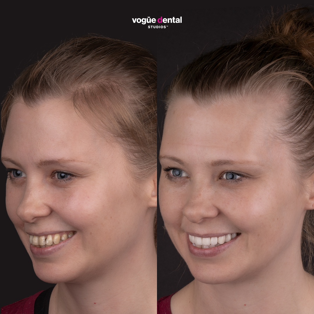 Elisabeth before and after thin enamel smile makeover Bring Back a Smile Foundation - left view