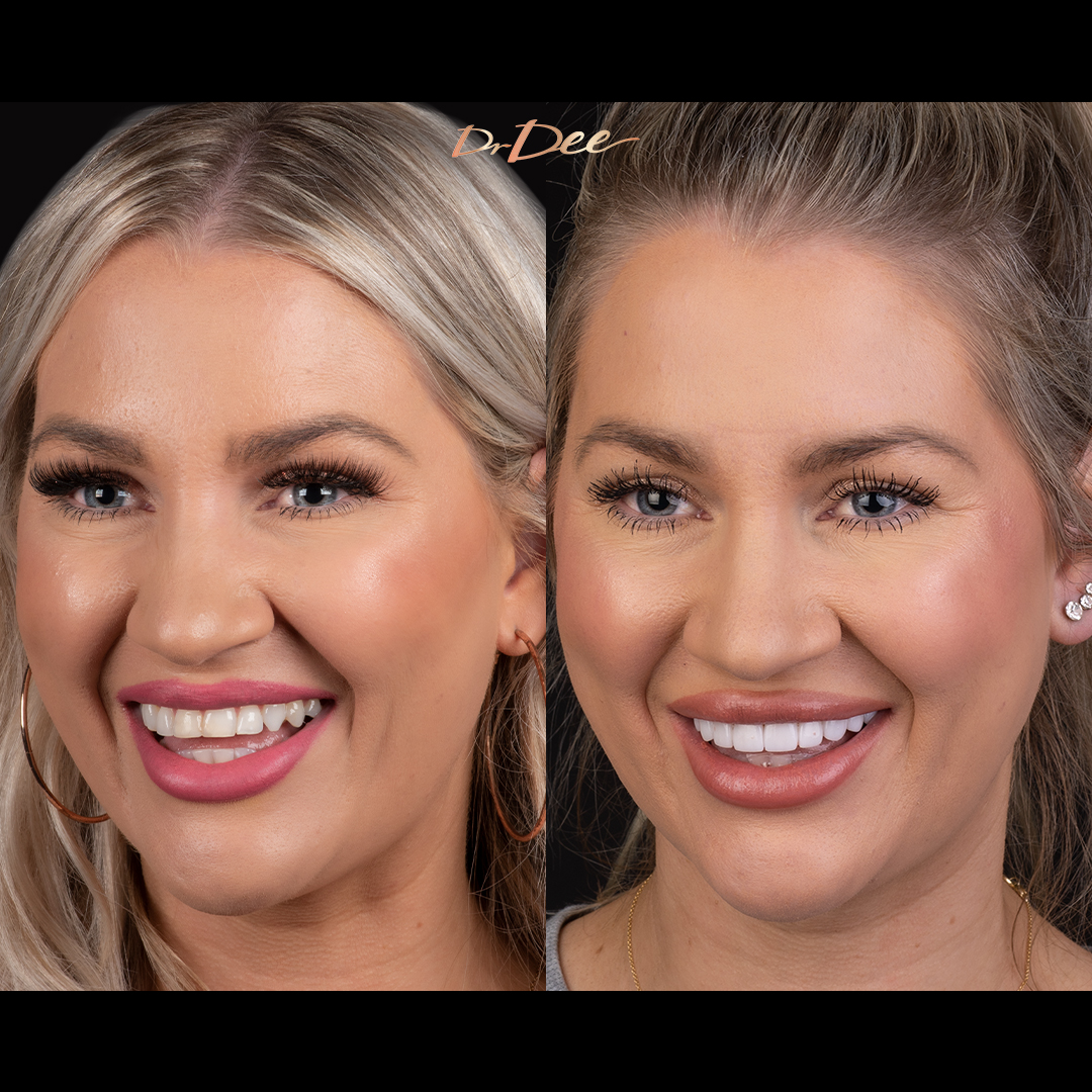 Before and after porcelain veneers at Vogue Dental Studios - left view Jessica