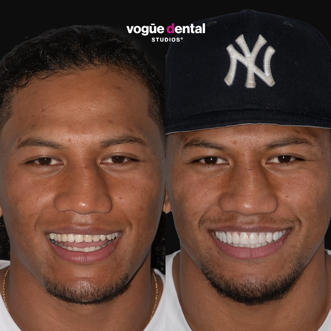 Sitili Tupouniua before and after porcelain veneers Vogue Dental Studios - full face front