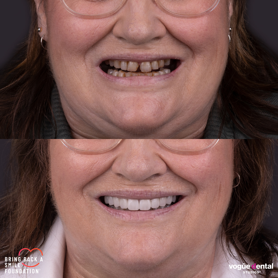 Judy smile restoration after stress vomiting at Bring Back a Smile Foundation