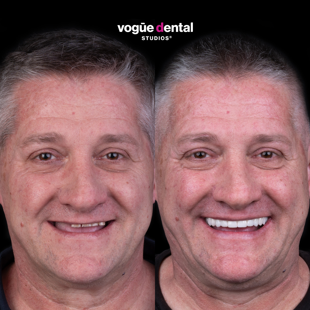 Before and after implant smile makeover at Vogue Dental Studios - front view John