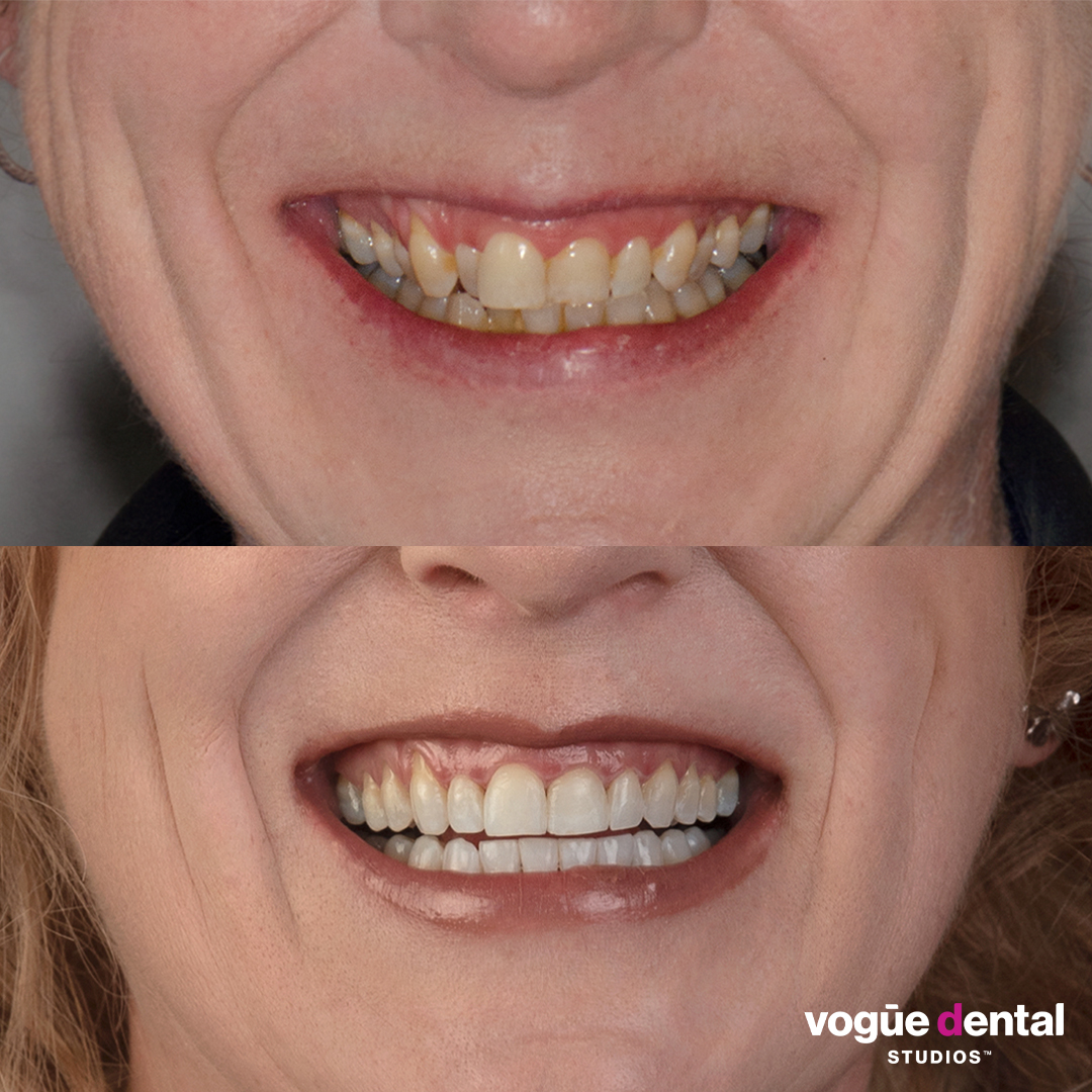 Kylie before and after veneers at Vogue Dental Studios - half face view