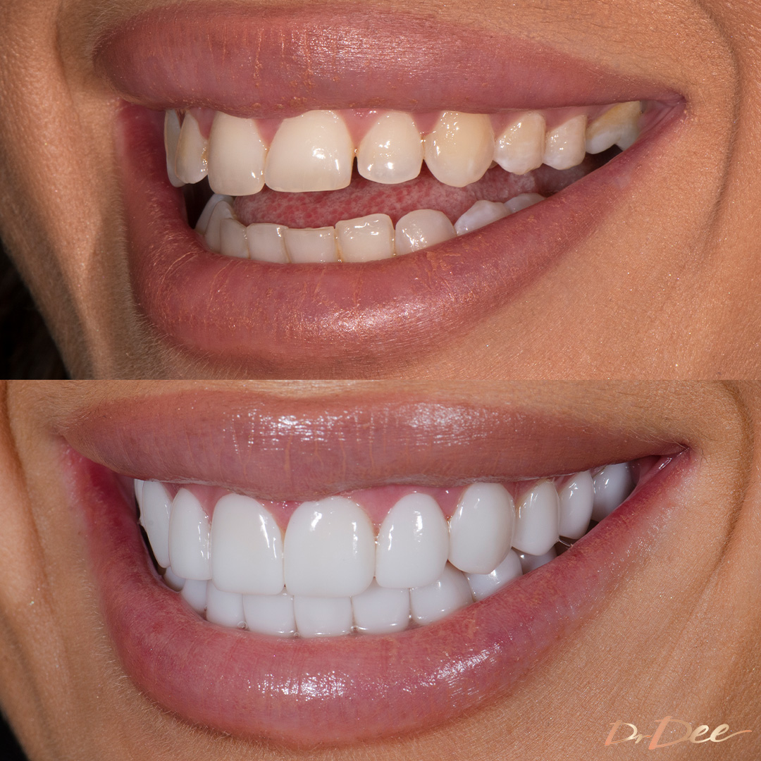 Before and after porcelain veneers smile makeover at Vogue Dental Studios - left teeth view Selin